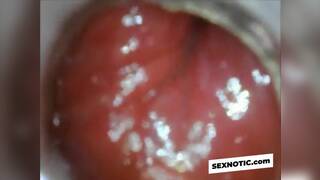 anal endoscope ass play from inside